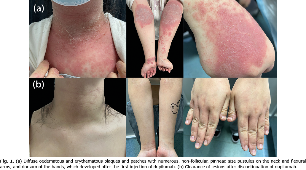 Gpp Rash CASE REPORT