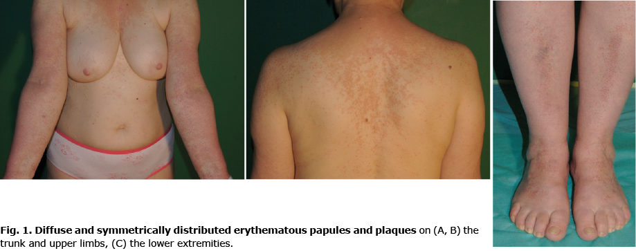 myelodysplastic syndrome skin