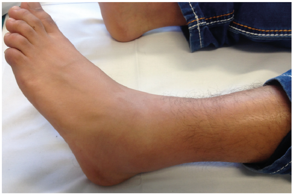 Fig. 3. Patient with familial Mediterranean fever with erysipelas-like ...