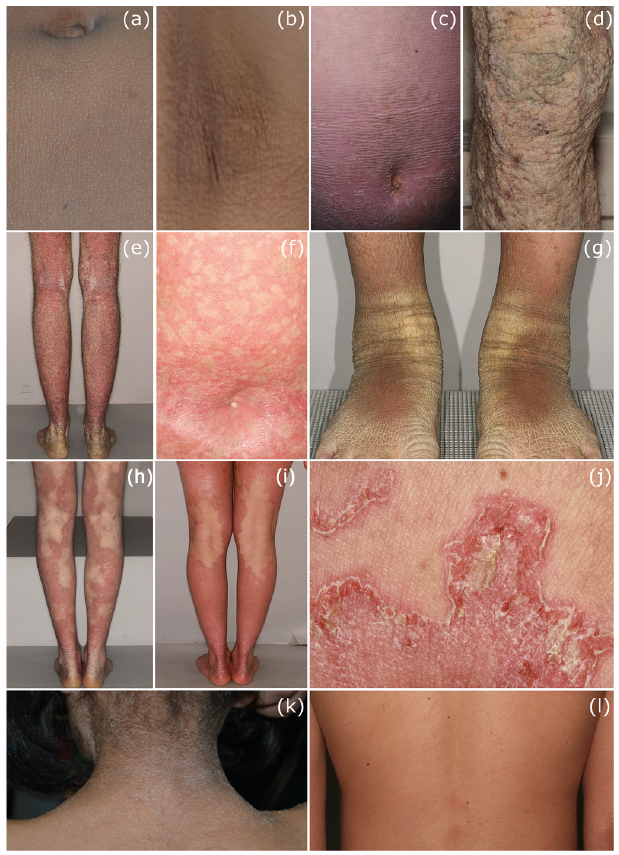 lamellar ichthyosis treatment