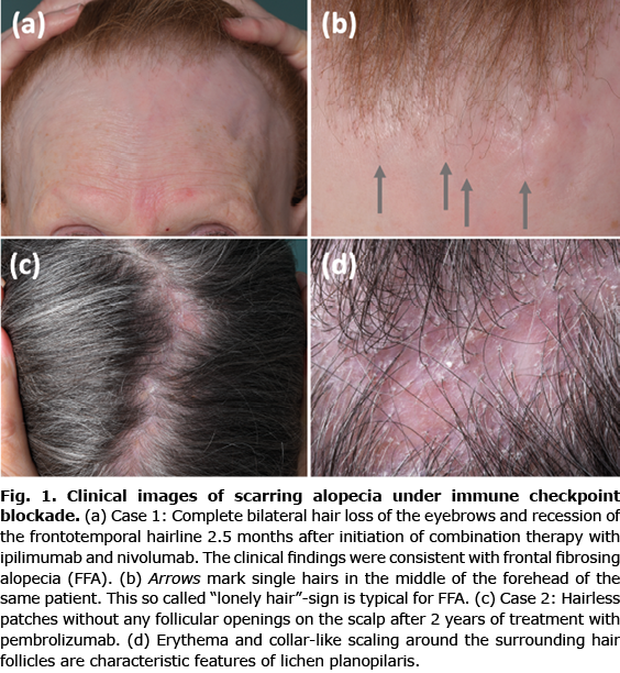 follicular hyperkeratosis scalp