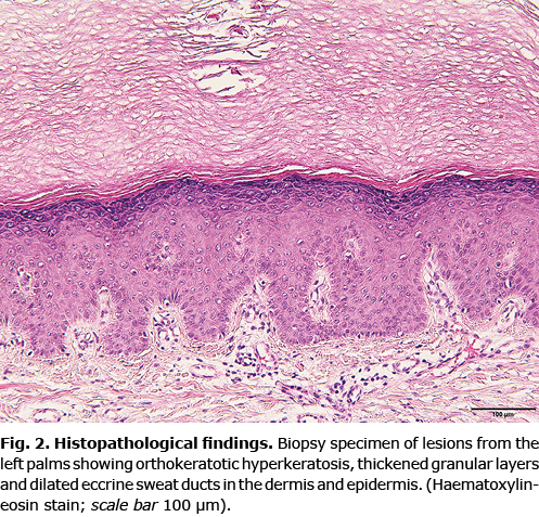 Diagnosis: Aquagenic syringeal acrokeratoderma