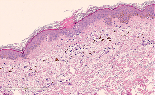 Annular Pigmented Macules on the Upper Trunk: A Quiz