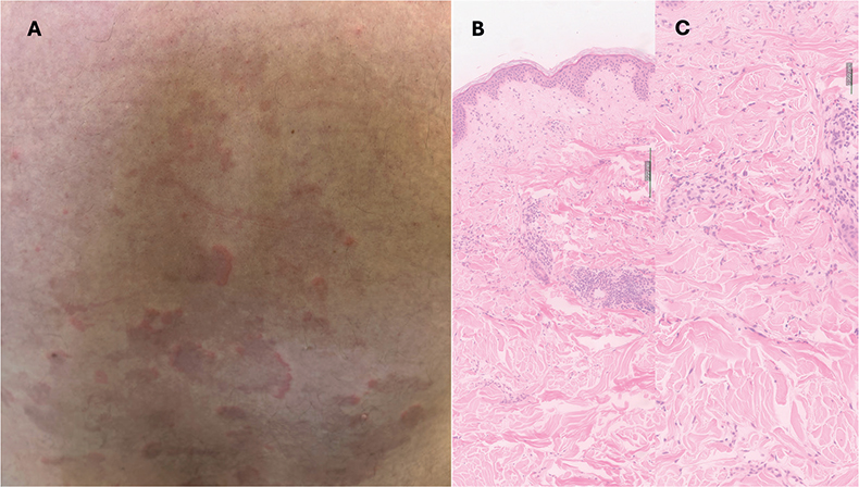 Annulaur Rash Diffuse Chronic Pruritic Annular Rash in a 47-year-old Man: A Quiz