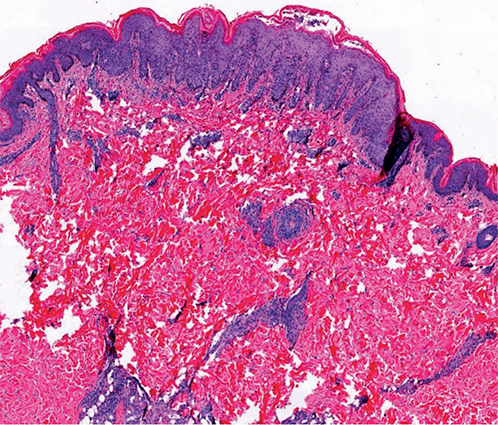 Febrile Ulceronecrotic Mucha-habermann Disease: A Case Report And 