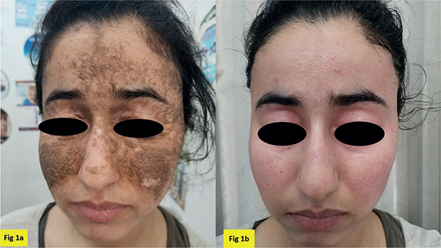 A Cornflake-like Dermatitis: A Quiz