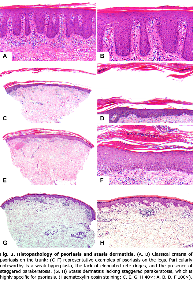 Eczematous Dermatitis Histopathology