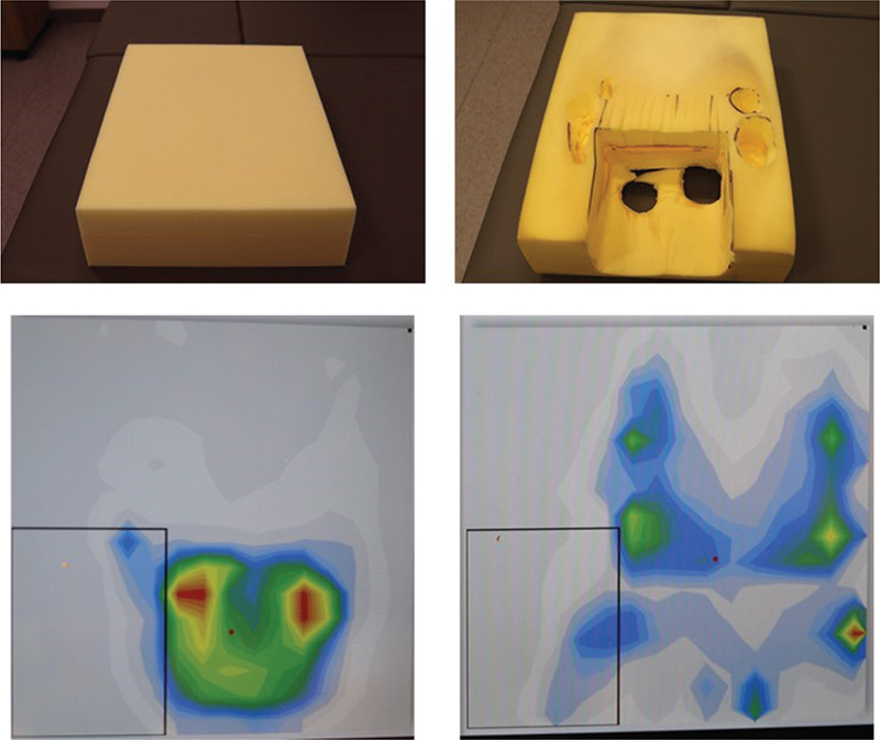OFF-LOADING PRESSURE RELIEF WITH FOAM CUT OUT CUSHIONS: EXPERIENCES ...