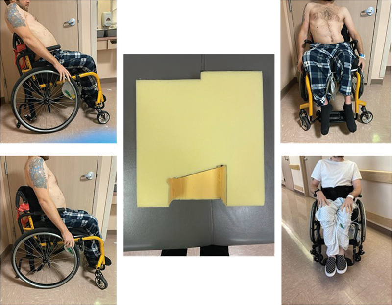 OFF-LOADING PRESSURE RELIEF WITH FOAM CUT OUT CUSHIONS: EXPERIENCES ...